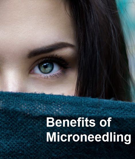 Benefits of Microneedling