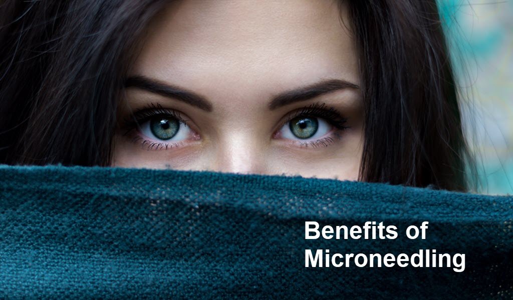 5 Benefits Of Microneedling
